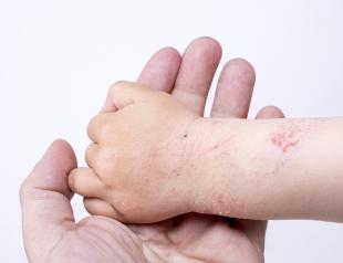 zakaj'являються шорсткі плями на шкірі у дитини