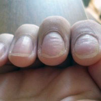 O kojoj boji ploče za nokte govori. Kako odrediti ljudsku bolest na noktima?