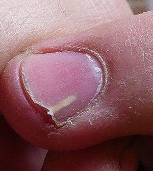 Unterm fingernagel eiter Nagelbettentzündung: Symptome