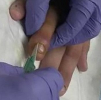Unterm fingernagel eiter Nagelbettentzündung Behandlung: