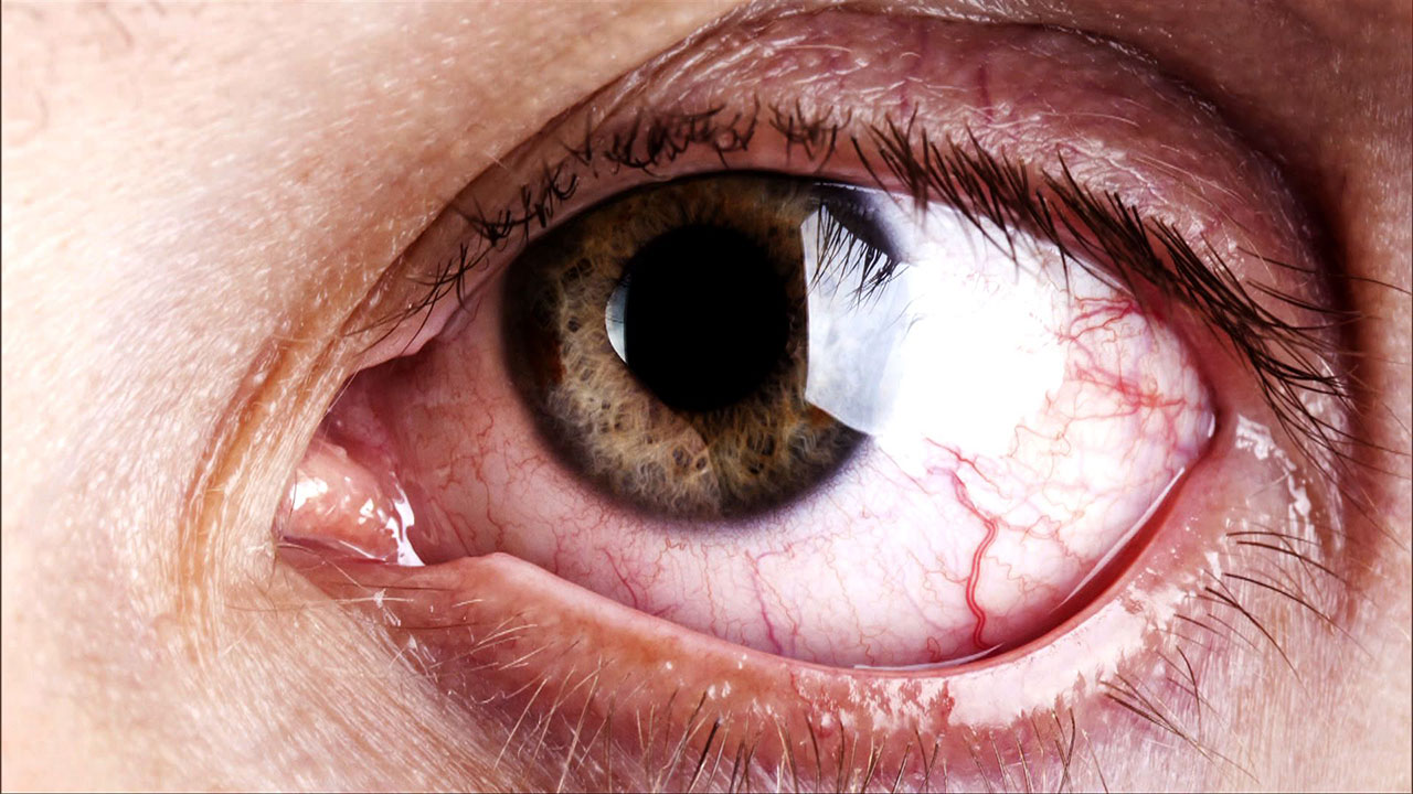 Чому червоніють зіниці очей. Лікування червоних очей, їх можливі причини