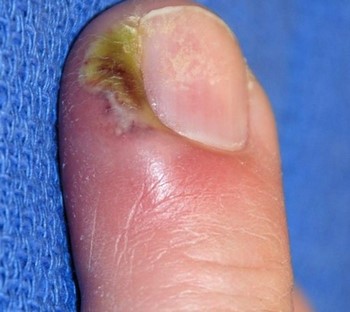 Fingernagel eiter unterm Welche Krankheiten