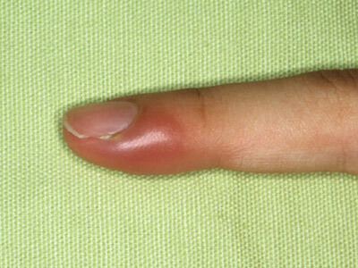 Gnojni prst. Kako ukloniti macu iz nokta uz pomoć terapijskih kupališta. Zašto je GUP formiran ispod nokta i šta da radi?