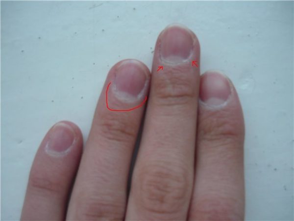 Wenn ein Finger in der Nähe des Nagels wurde. Arten von systemischen Erkrankungen. Volksmittel und Kräuter.