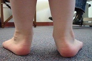 Чи можна виправити вальгусную стопу. Особливості вальгусной деформації стопи. Ортопедичне взуття і устілки.