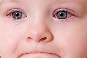 يسقط من التهاب الملتحمة للأطفال حديثي الولادة والأطفال الأكبر سنا. قطرات العين من التهاب الملتحمة للأطفال والمواليد الجدد.