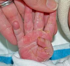 يرى الطفل الجلد على إصبعه. لماذا يصطاد الطفل الجلد على يديه