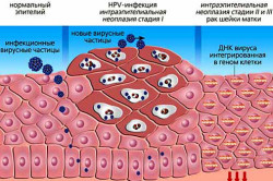 Lijekovi iz HPV-a kod žena. Ženski virus papiloma: simptomi i znakovi. Sigurni načini samo-uklanjanja bradavica.