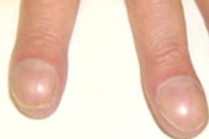 Здоров'я по нігтях на ногах. Що можуть розповісти нігті про наше здоров'я?