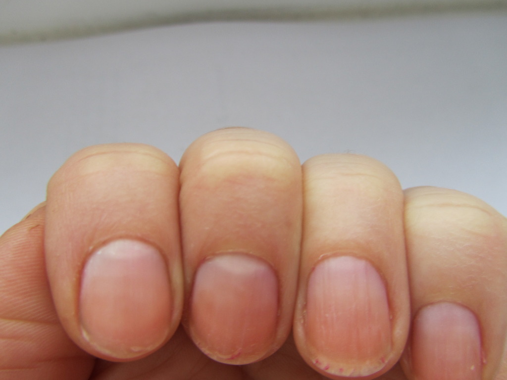 Konveksne nokte. Dijagnosticiranje tijela u pojavi noktiju i nogu. Šta nokti govore o zdravlju ljudi?