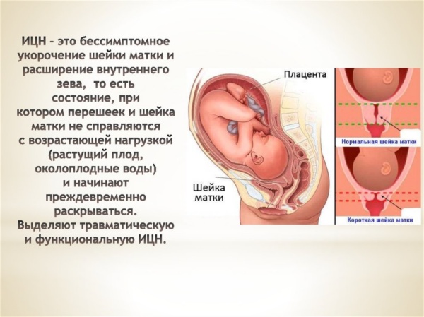نغمة الرحم pіd h vagītnostі في فترات مبكرة.  الأسباب والأعراض والعلاج وكيفية التعرف عليها وكيفية العمل