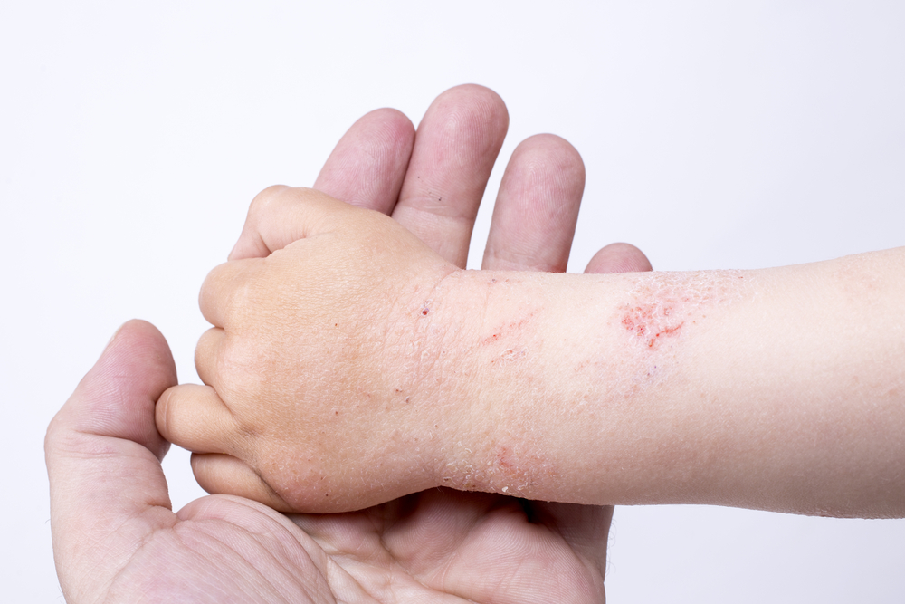 Яагаад'являються шорсткі плями на шкірі у дитини