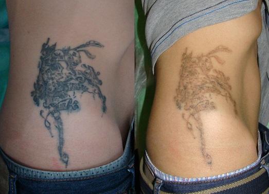 Як правильно вивести татуювання з тіла?