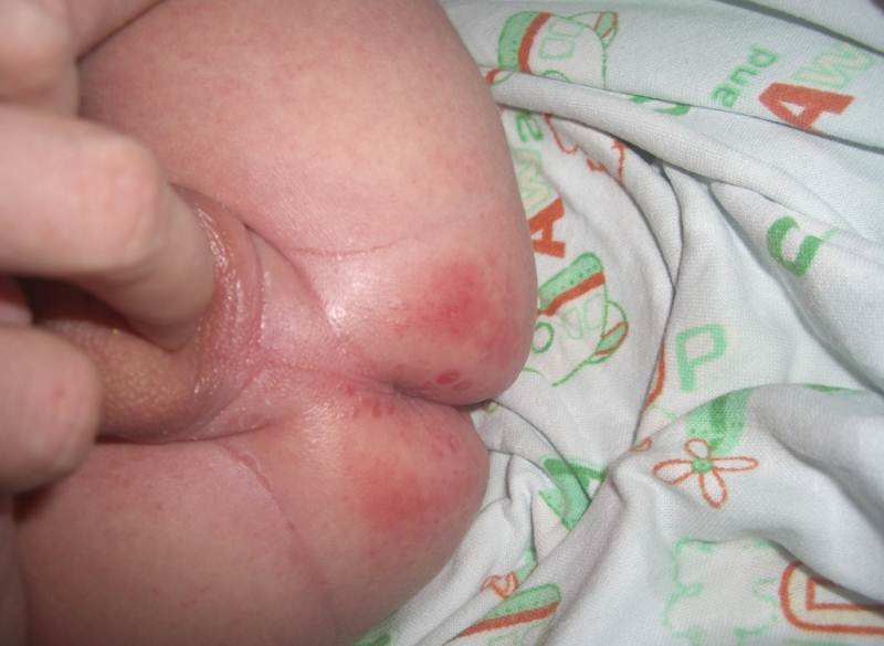 So schmieren Sie den roten Hintern eines Kindes: Anti-Schweiß-Pflege